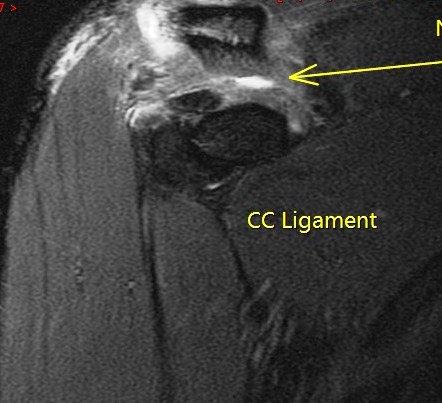 Figure 5 for case Grade 3 AC separation ( RID1895 )